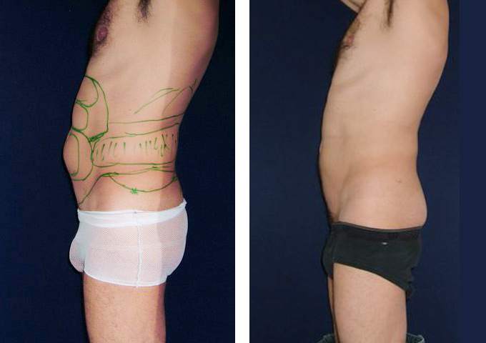 Vor und nach einer Behandlung von Bauch und Hüfte durch Fettabsaugung
