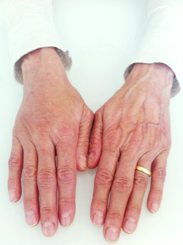 Die rechte Hand nach einer Faltenbehandlung zur Hautverjüngung im Vergleich zur linken Hand