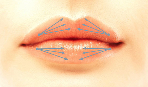 Lippenaufspritzen durch Fächertechnik mit der Nadel
