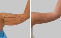 Vorher/nachher: Fettabsaugung und Straffung der Haut ohne Operation an den Oberarmen.